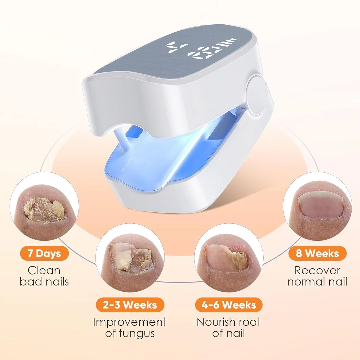 Appareil de thérapie laser pour ongles KTS 910nm/407nm – Anti-Mycose Puissant, Portable & Rechargeable